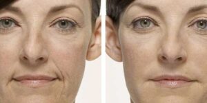 Erase Wrinkles Instantly: The Magic of Botox And Fillers