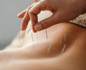 Role of Acupuncture