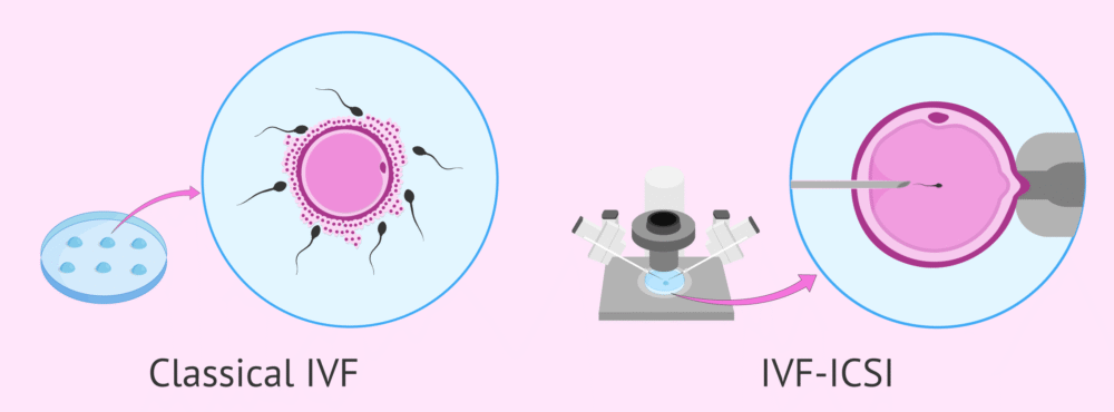 rituivf